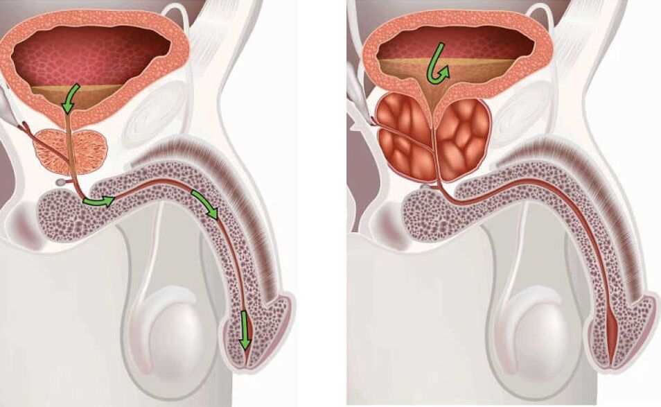 Inflamarea glandei prostatei
