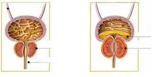 Tipuri și forme de prostatită la bărbați