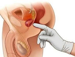 Masaj de prostată pentru tratamentul prostatitei la bărbați