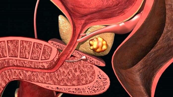Depuneri de pietre în prostată cu prostatita calculoasă