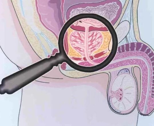 Prostatita