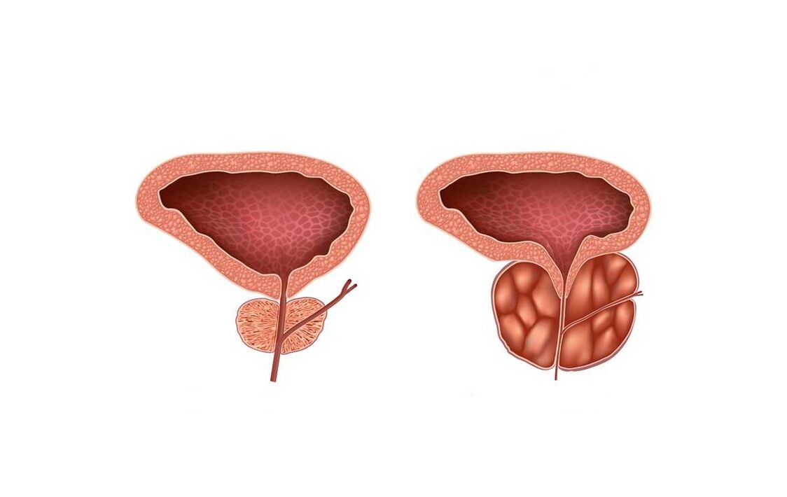 simptome de prostatita la barbati