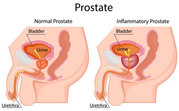 prostată sănătoasă și inflamată