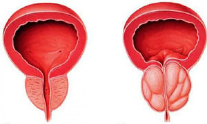 Prostată normală (stânga) și prostatita cronică inflamată (dreapta)