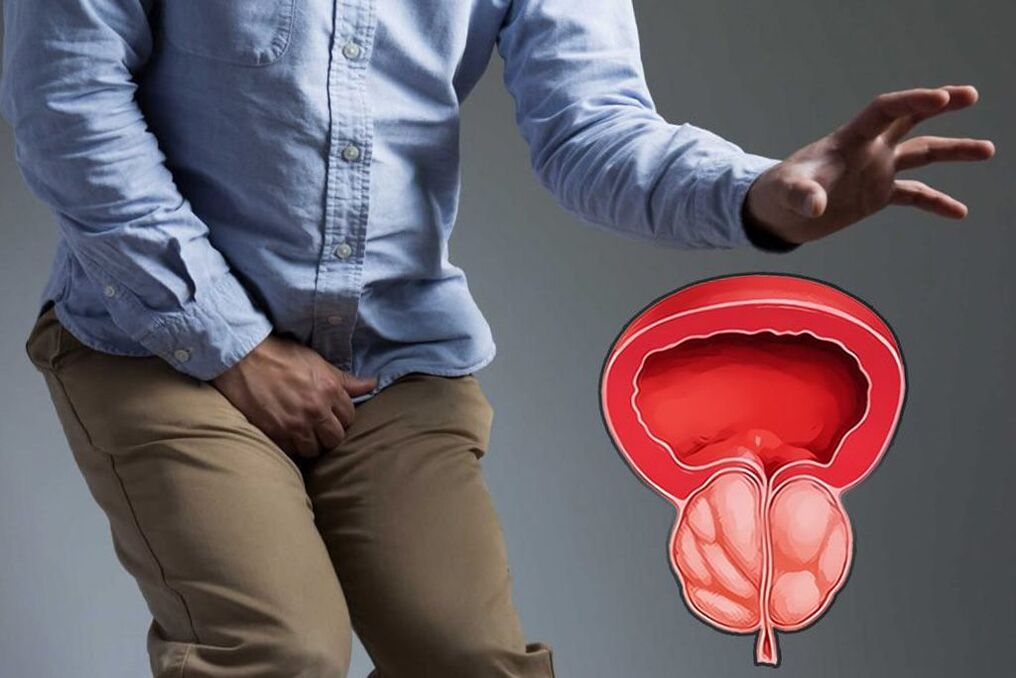 prostată acută la bărbați
