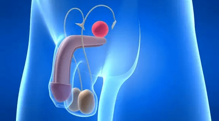Prostatita este o inflamație a glandei prostatei la bărbați, care necesită un tratament complex